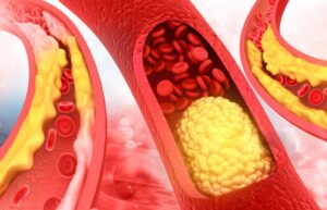 cholesterol